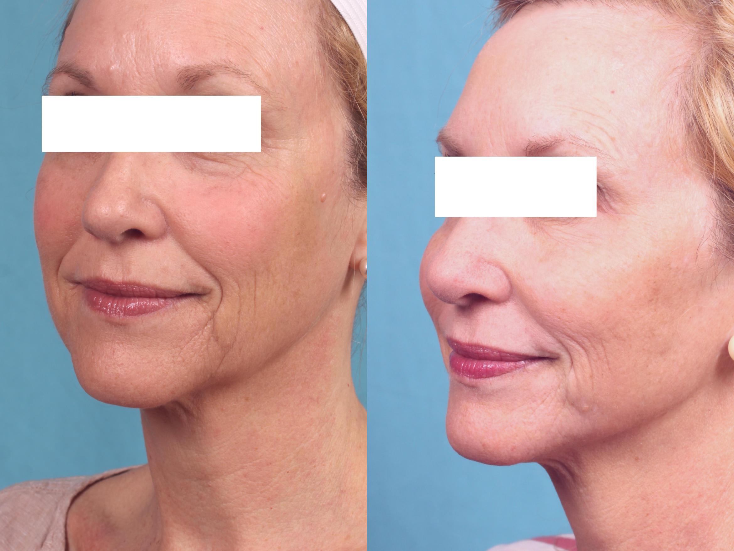 Best C02 Laser Skin Resurfacing In Dallas At Advanced Skin Fitness Medspa