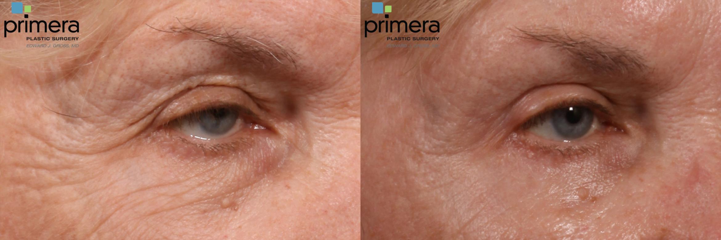 co2-laser-skin-resurfacing-with-upper-eyelid-lift