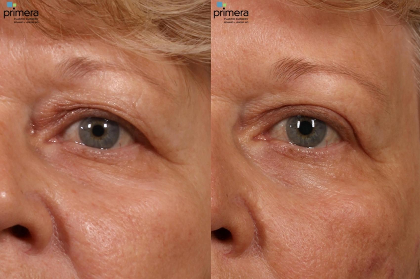 Before & After Blepharoplasty Case 16 view-1 View in Orlando, Florida
