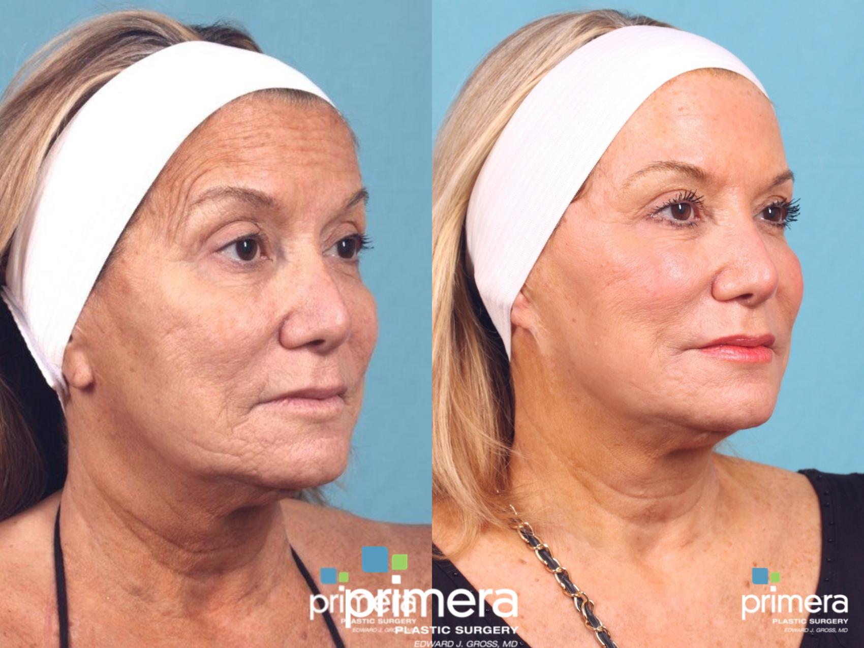 DOT CO2 Laser Resurfacing Before and After: See What’s Possible For ...