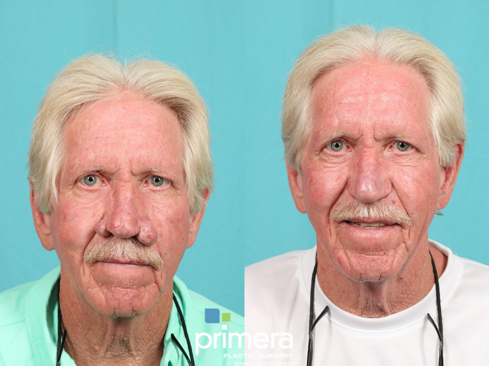 rhinophyma before after