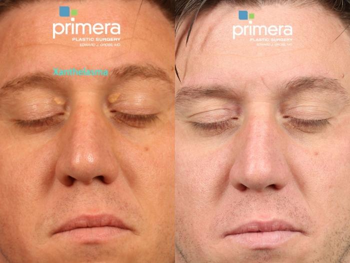 Before & After Skin Discoloration Treatment Case 591 Front View in Orlando, Florida