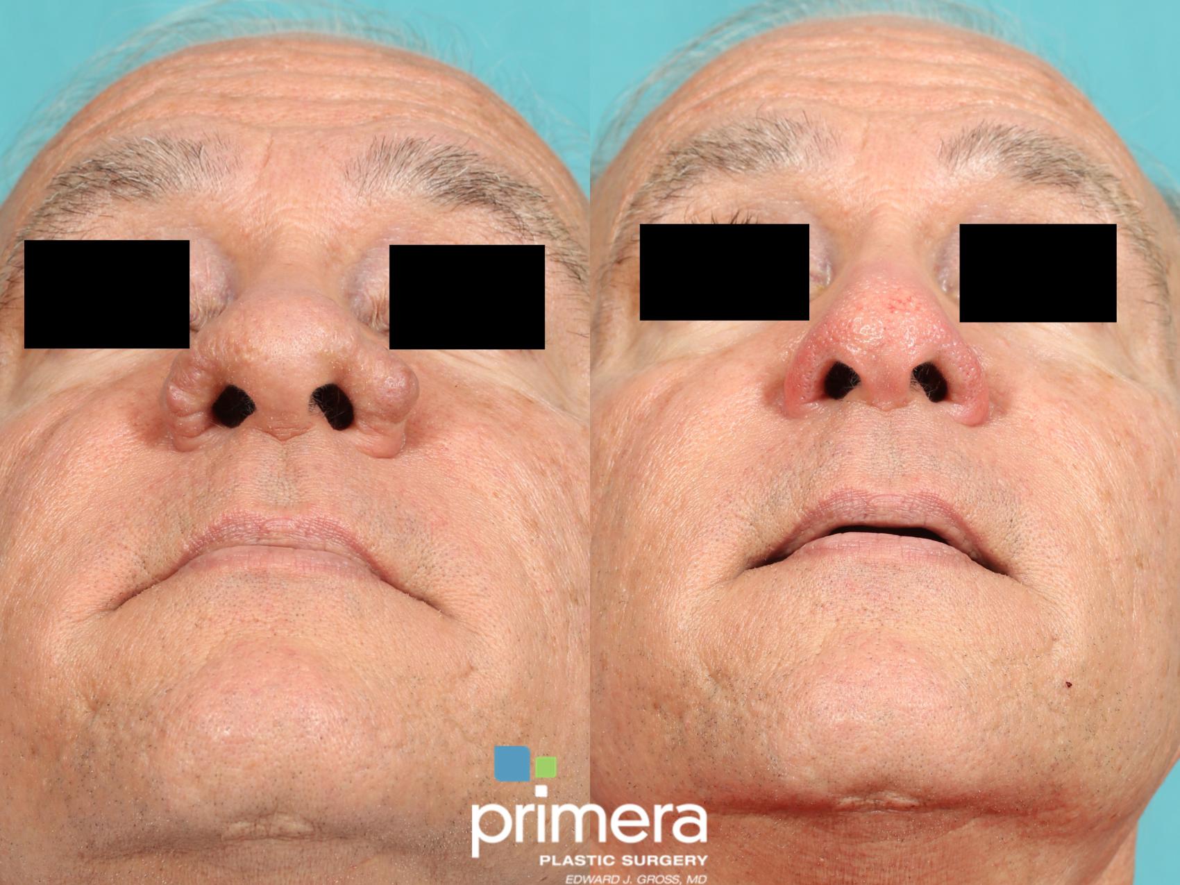 Rhinophyma Treatment- Orlando