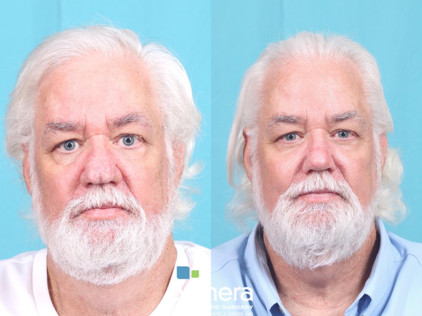 Rhinophyma Treatment- Orlando