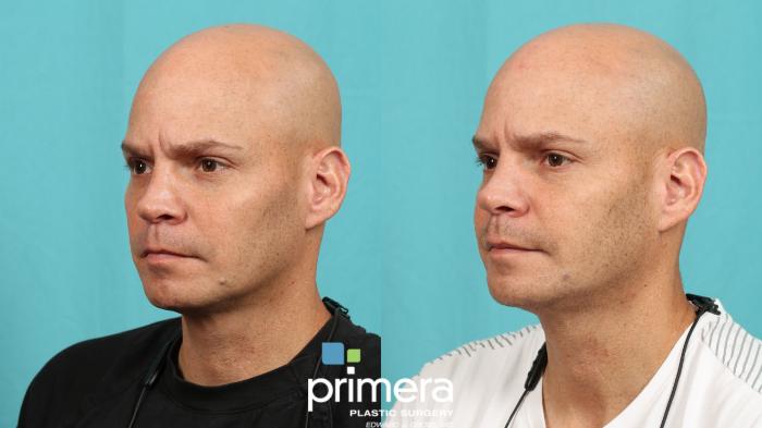 DOT CO2 Laser | Before & After | Primera Plastic Surgery | Orlando, FL
