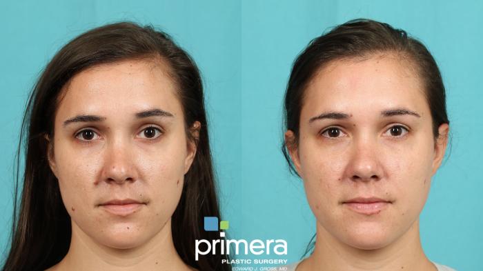 Laser Mole Removal | Before and After | Primera Plastic Surgery