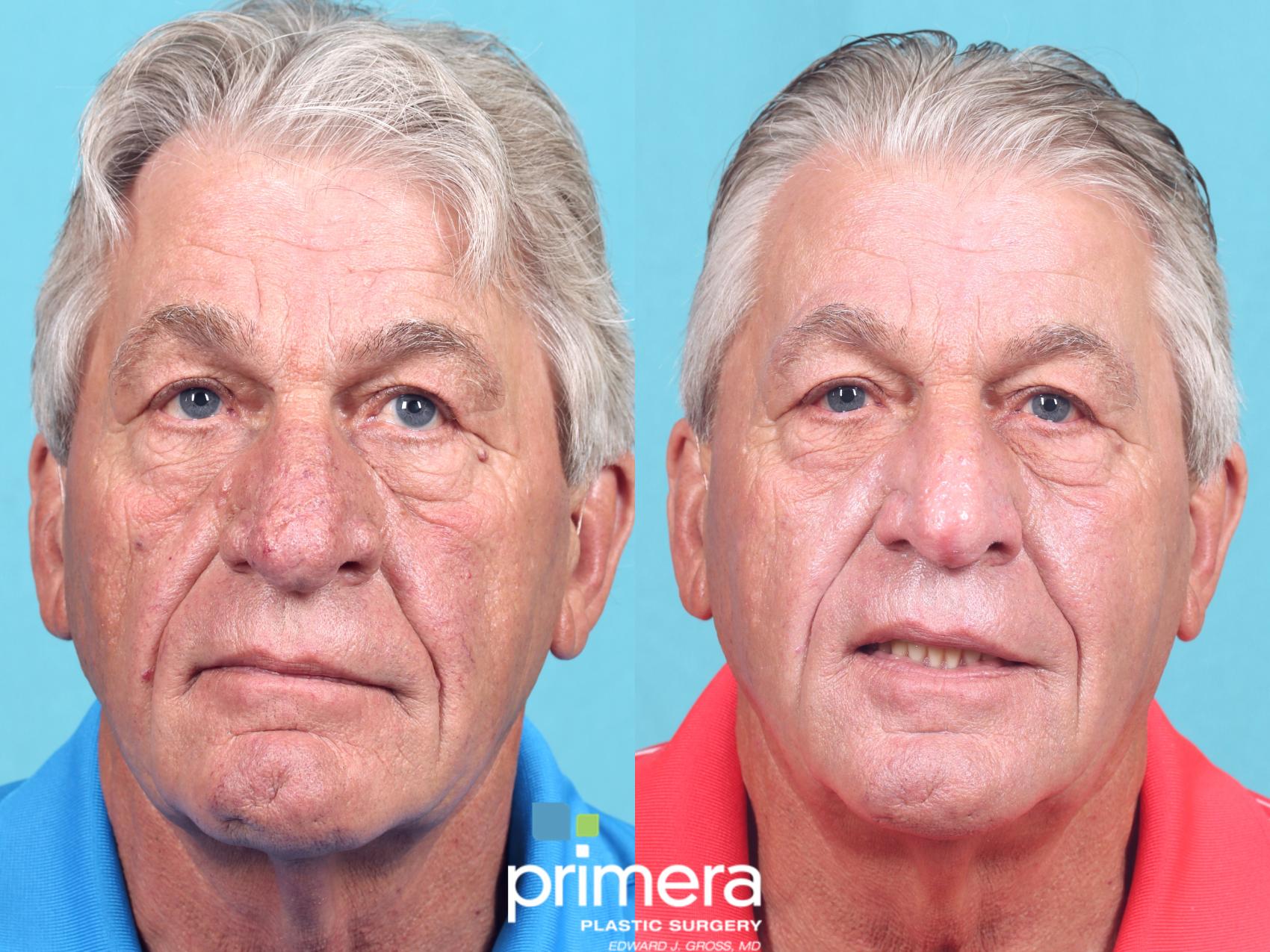 Laser Skin Resurfacing Dot Co2 Before And After Pictures Case 781 Orlando Florida Primera 2515