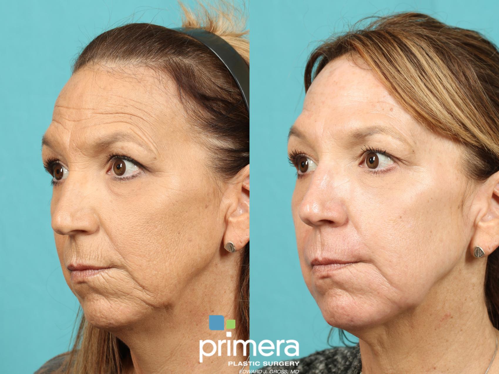 Laser Skin Resurfacing Dot Co2 Before And After Pictures Case 822 Orlando Florida Primera 3973