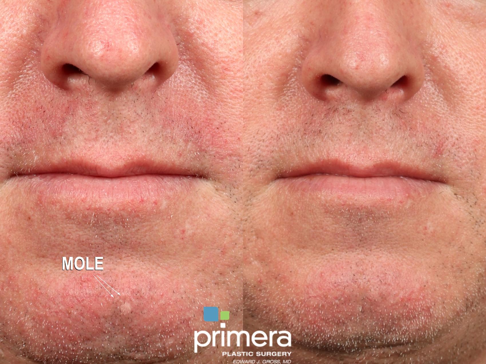 Before & After Laser Skin Resurfacing (DOT CO2) Case 841 Front View in Orlando, Florida
