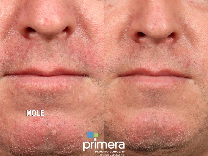 Before & After Surgery for Men Case 841 Front View in Orlando, Florida