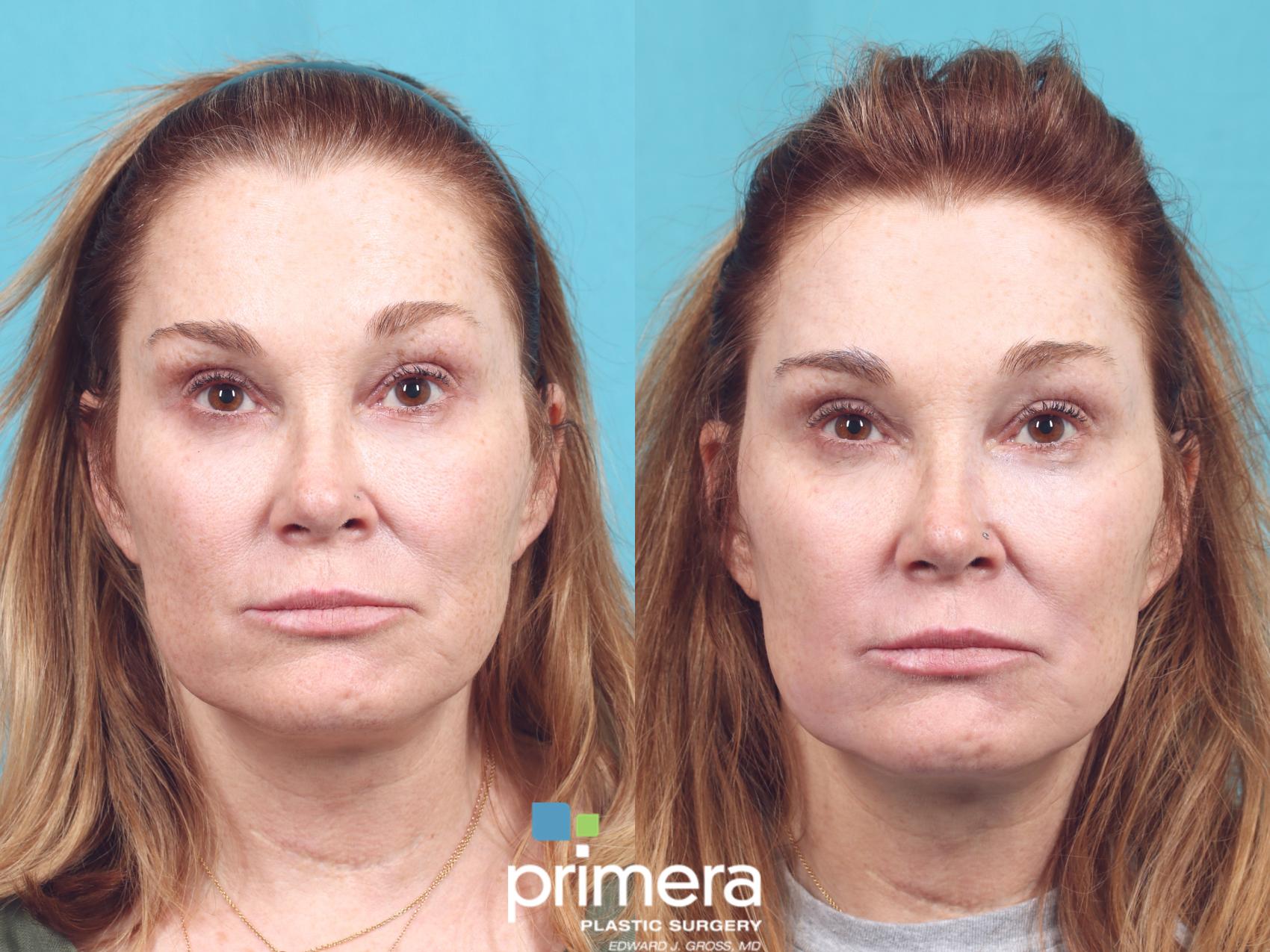 Laser Skin Resurfacing (DOT CO2) Before and After Pictures Case 859