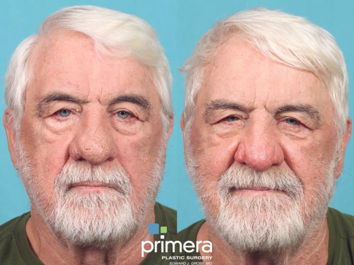 Before & After Surgery for Men Case 916 Front View in Orlando, Florida