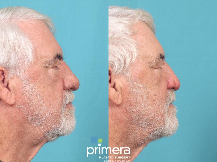 Before & After Surgery for Men Case 916 Right Side View in Orlando, Florida