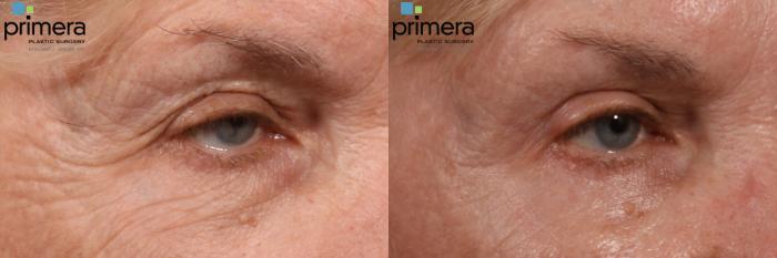 Before & After Blepharoplasty Case 94 view-1 View in Orlando, Florida