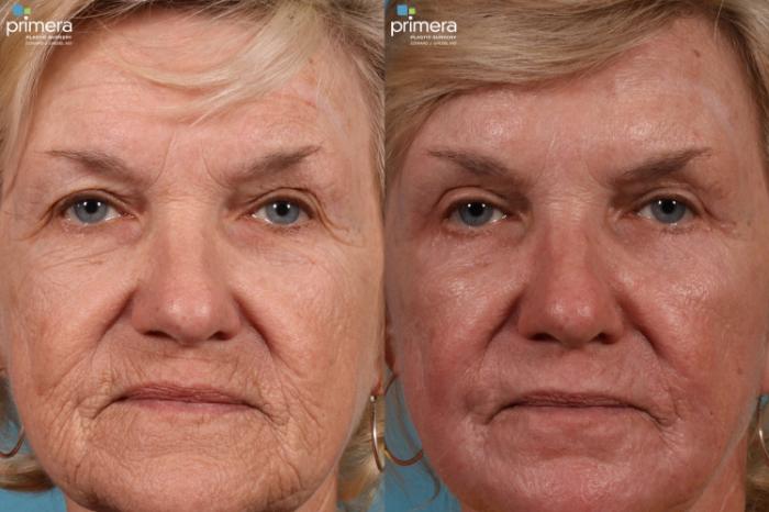 Before & After Blepharoplasty Case 94 view-2 View in Orlando, Florida