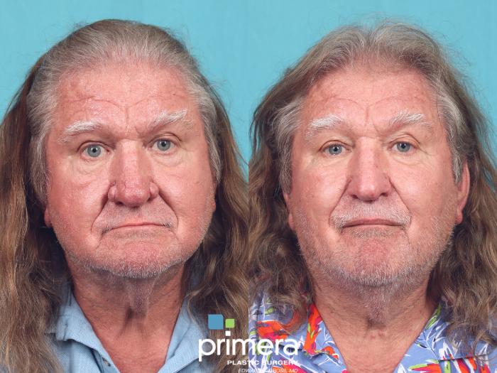 Before & After Facial Scarring Case 945 Front View in Orlando, Florida