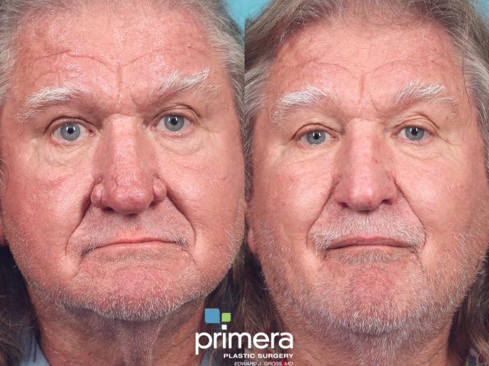 Before & After Facial Scarring Case 945 Front View View in Orlando, Florida