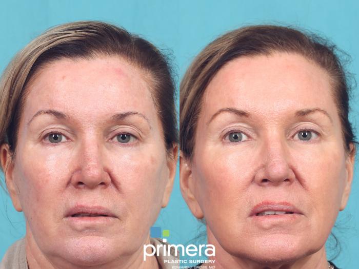 Before & After Laser Skin Resurfacing (DOT CO2) Case 947 Front View in Orlando, Florida