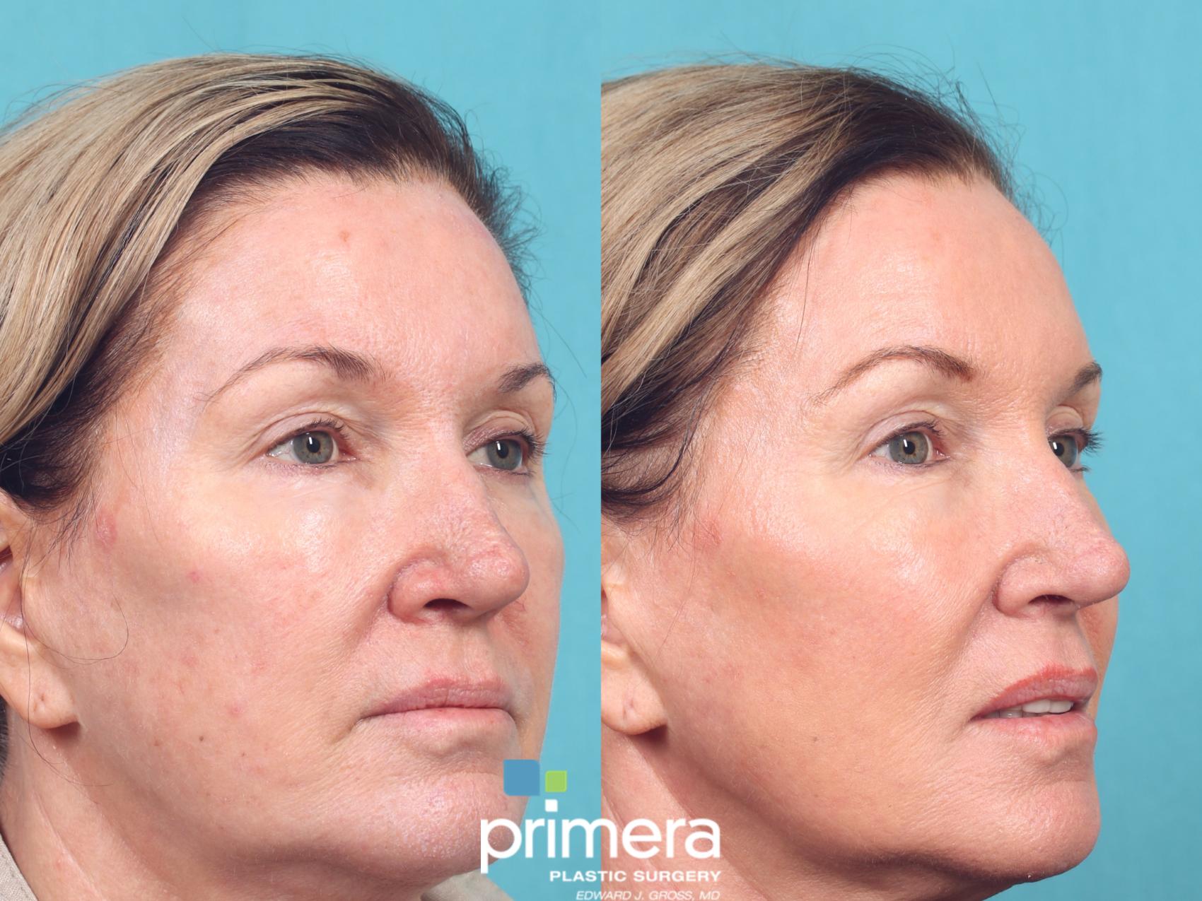 Before & After Laser Skin Resurfacing (DOT CO2) Case 947 Right Oblique View in Orlando, Florida
