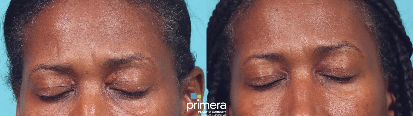 Before & After Laser Skin Resurfacing (DOT CO2) Case 968 Front View in Orlando, Florida