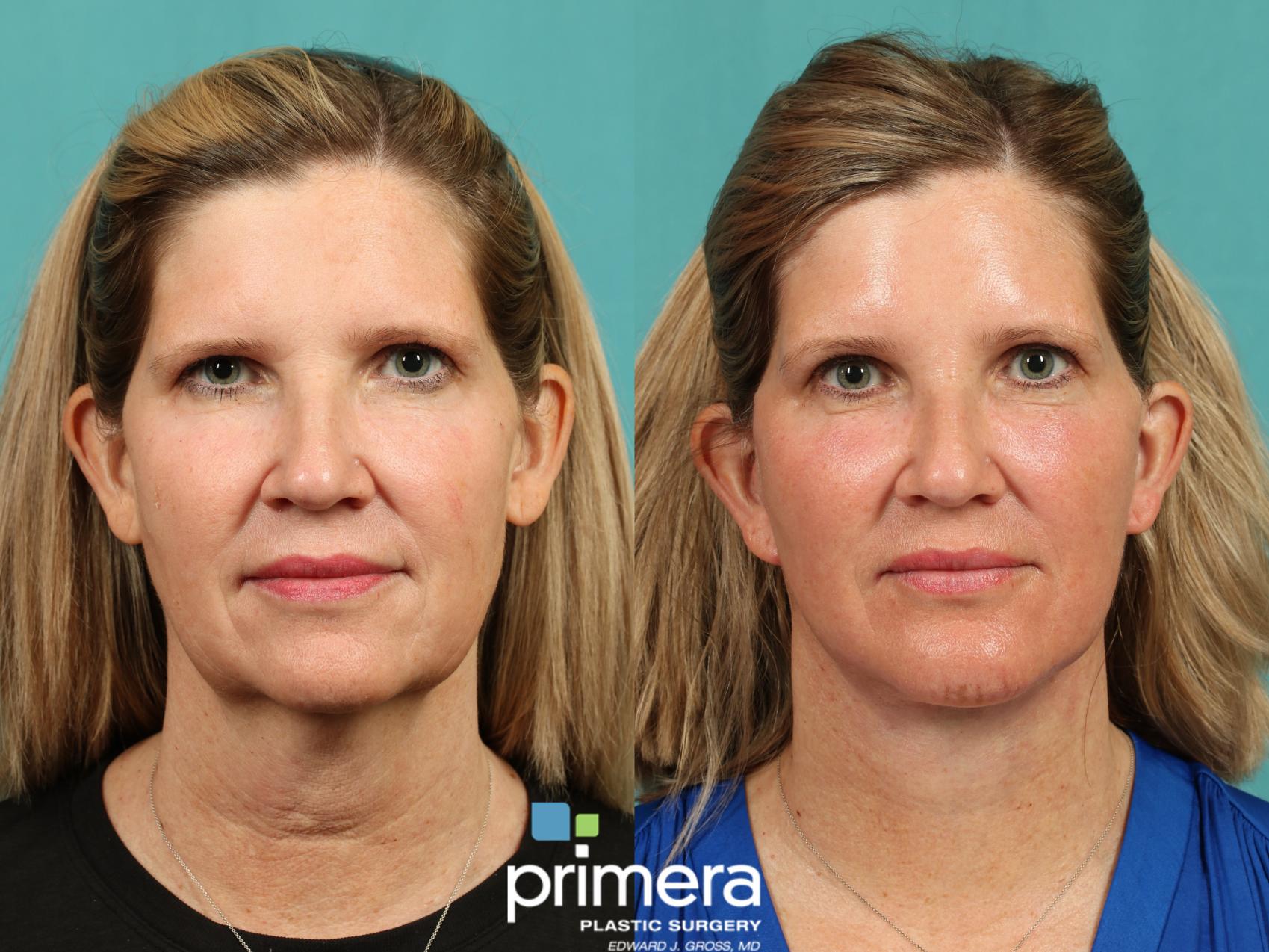 Before & After Neck & Face Liposuction Case 1009 Front View in Orlando, Winter Park & Tampa, Florida
