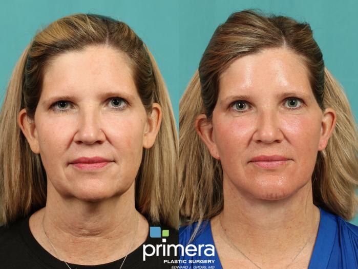 Before & After Neck & Face Liposuction Case 1009 Front View in Orlando, Winter Park & Tampa, Florida