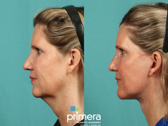 Before & After Neck & Face Liposuction Case 1009 Left Side View in Orlando, Winter Park & Tampa, Florida