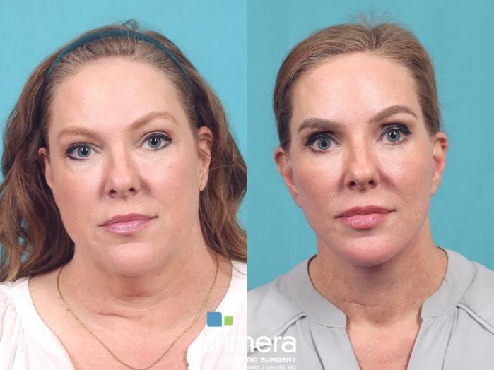 Before & After Neck & Face Liposuction Case 1027 Front View in Orlando, Winter Park & Tampa, Florida