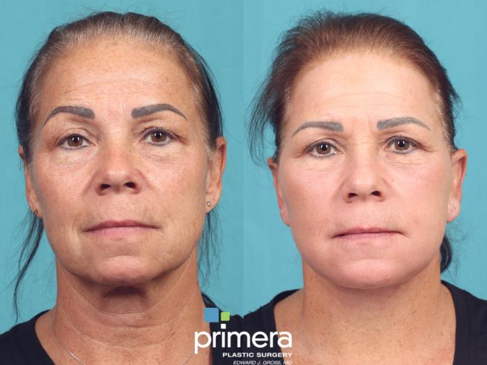 Before & After Laser Skin Resurfacing (DOT CO2) Case 1034 Front View in Orlando, Winter Park & Tampa, Florida