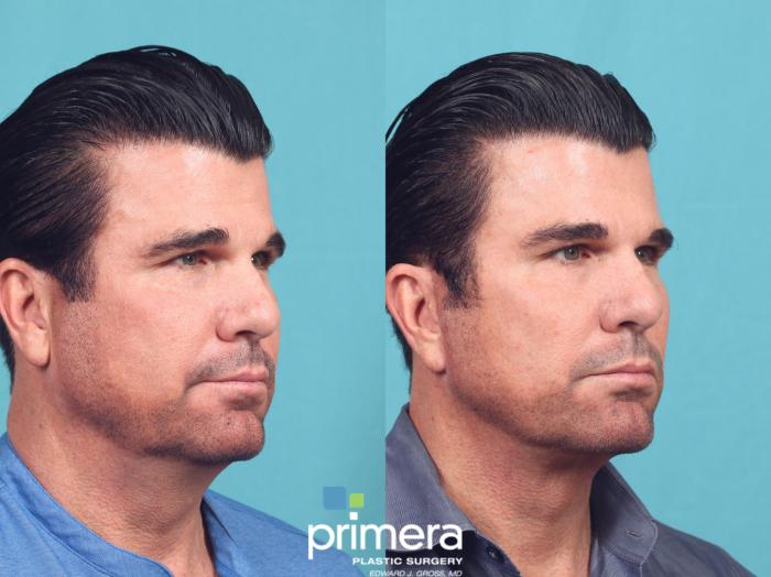 Before & After Neck & Face Liposuction Case 1044 Right Oblique View in Orlando, Winter Park & Tampa, Florida