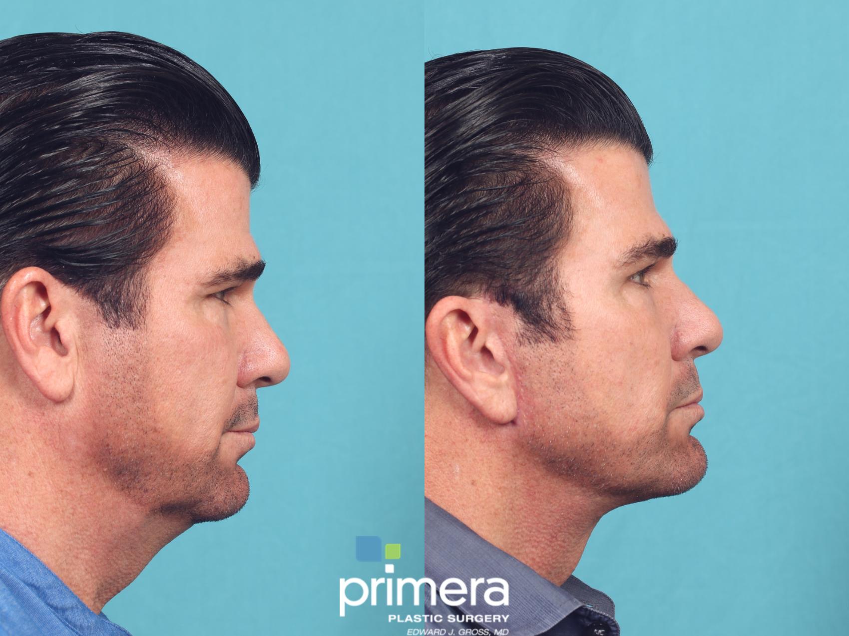 Before & After Neck & Face Liposuction Case 1044 Right Side View in Orlando, Winter Park & Tampa, Florida