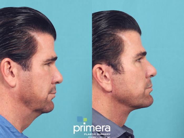 Before & After Neck & Face Liposuction Case 1044 Right Side View in Orlando, Winter Park & Tampa, Florida