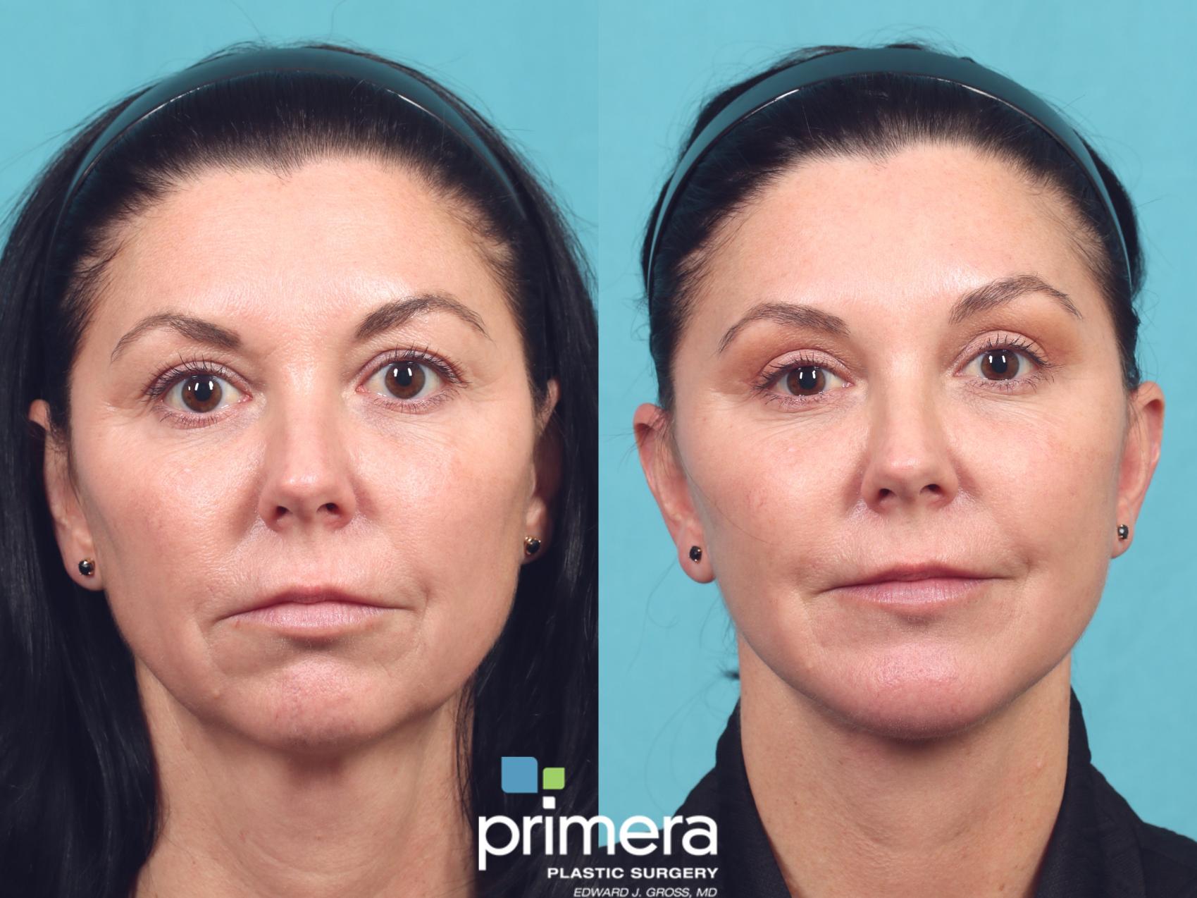 Before & After Mini Facelift Case 1048 Front View in Orlando, Winter Park & Tampa, Florida