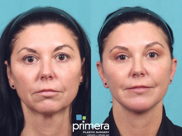 Before & After Mini Facelift Case 1048 Front View in Orlando, Winter Park & Tampa, Florida