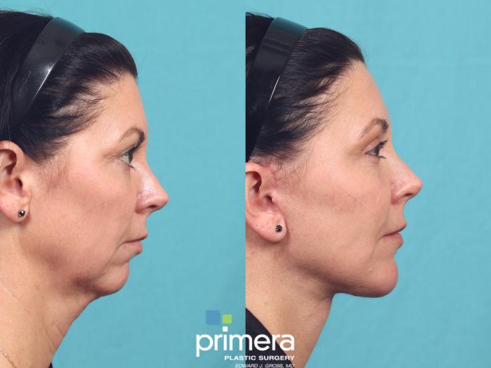 Before & After Mini Facelift Case 1048 Right Side View in Orlando, Winter Park & Tampa, Florida