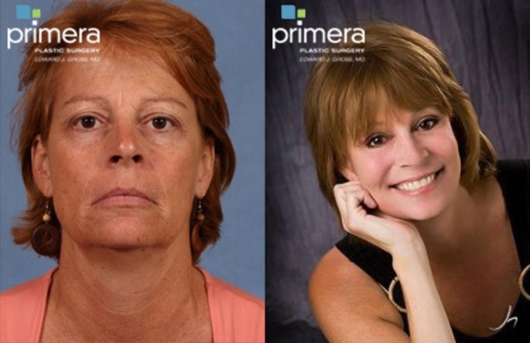 Mini Facelift Before After Photo Gallery Orlando Florida Primera Plastic Surgery