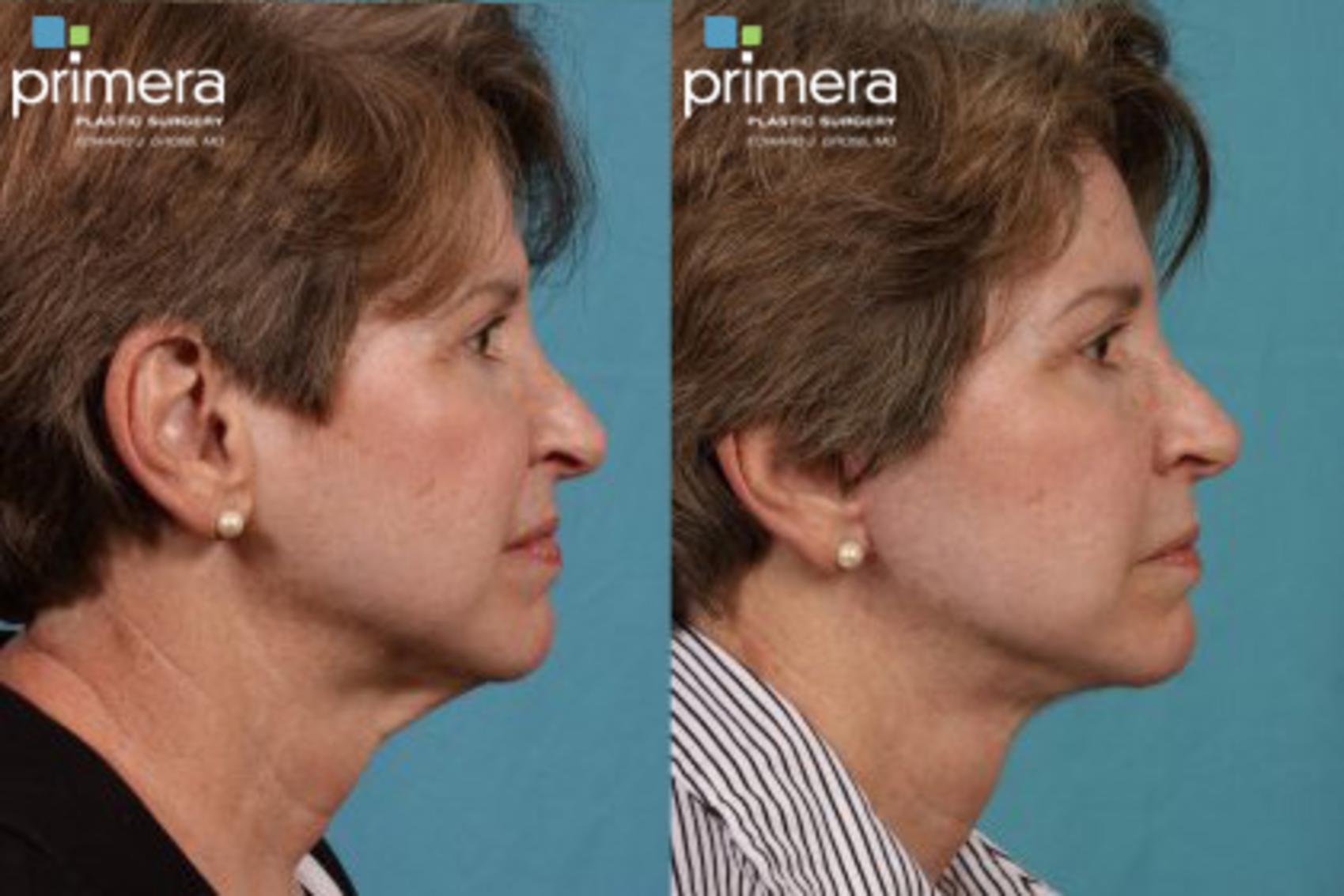 Neck Face Liposuction Before After Photo Gallery Orlando Florida Primera Plastic Surgery