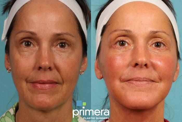 Before & After Mini Facelift Case 195 view-1 View in Orlando, Florida