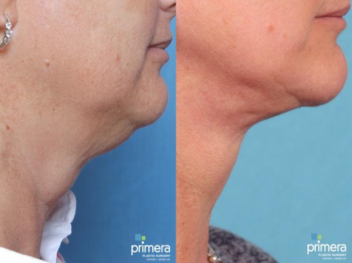 Before & After Neck & Face Liposuction Case 203 view-1 View in Orlando, Florida