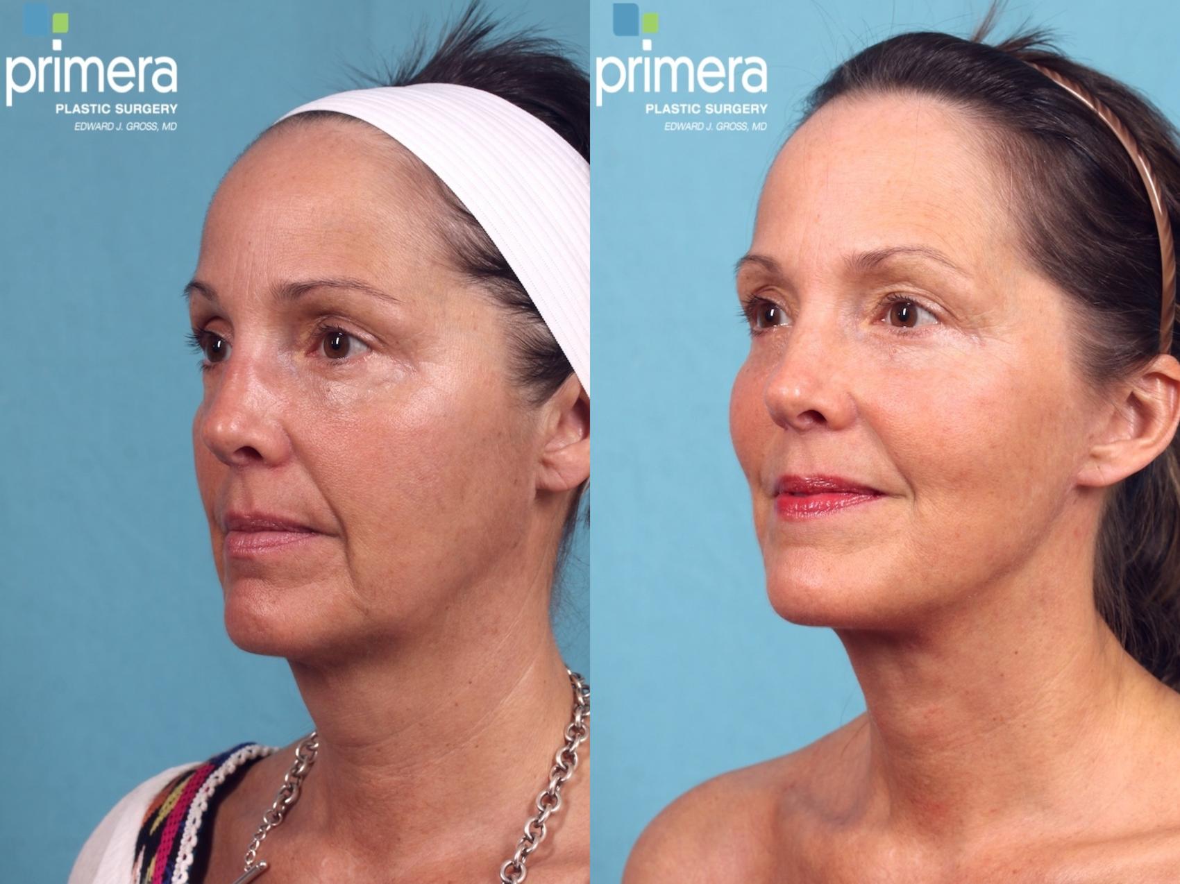 Before & After Mini Facelift Case 326 view-1 View in Orlando, Florida