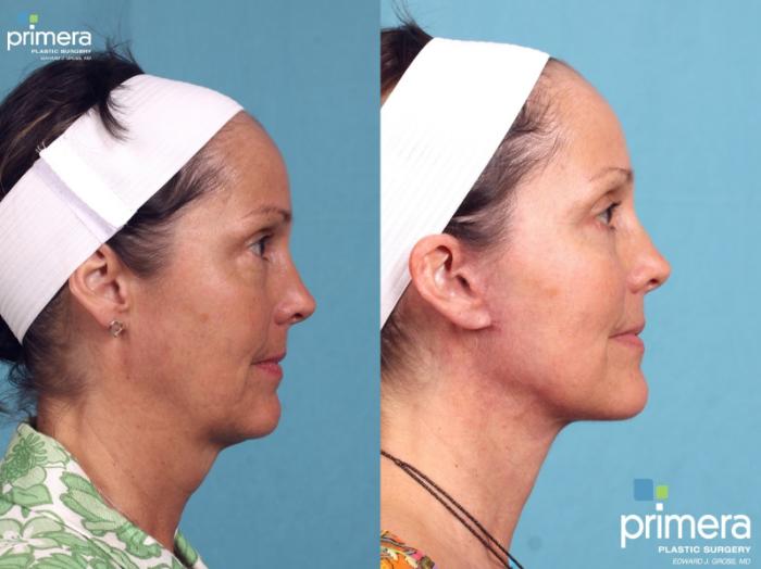 Before & After Mini Facelift Case 326 view-2 View in Orlando, Florida
