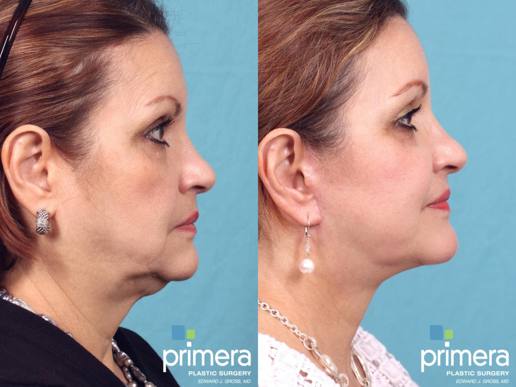 Before & After Neck & Face Liposuction Case 358 view-1 View in Orlando, Florida