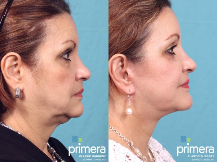 Before & After Facelift Case 358 view-1 View in Orlando, Florida