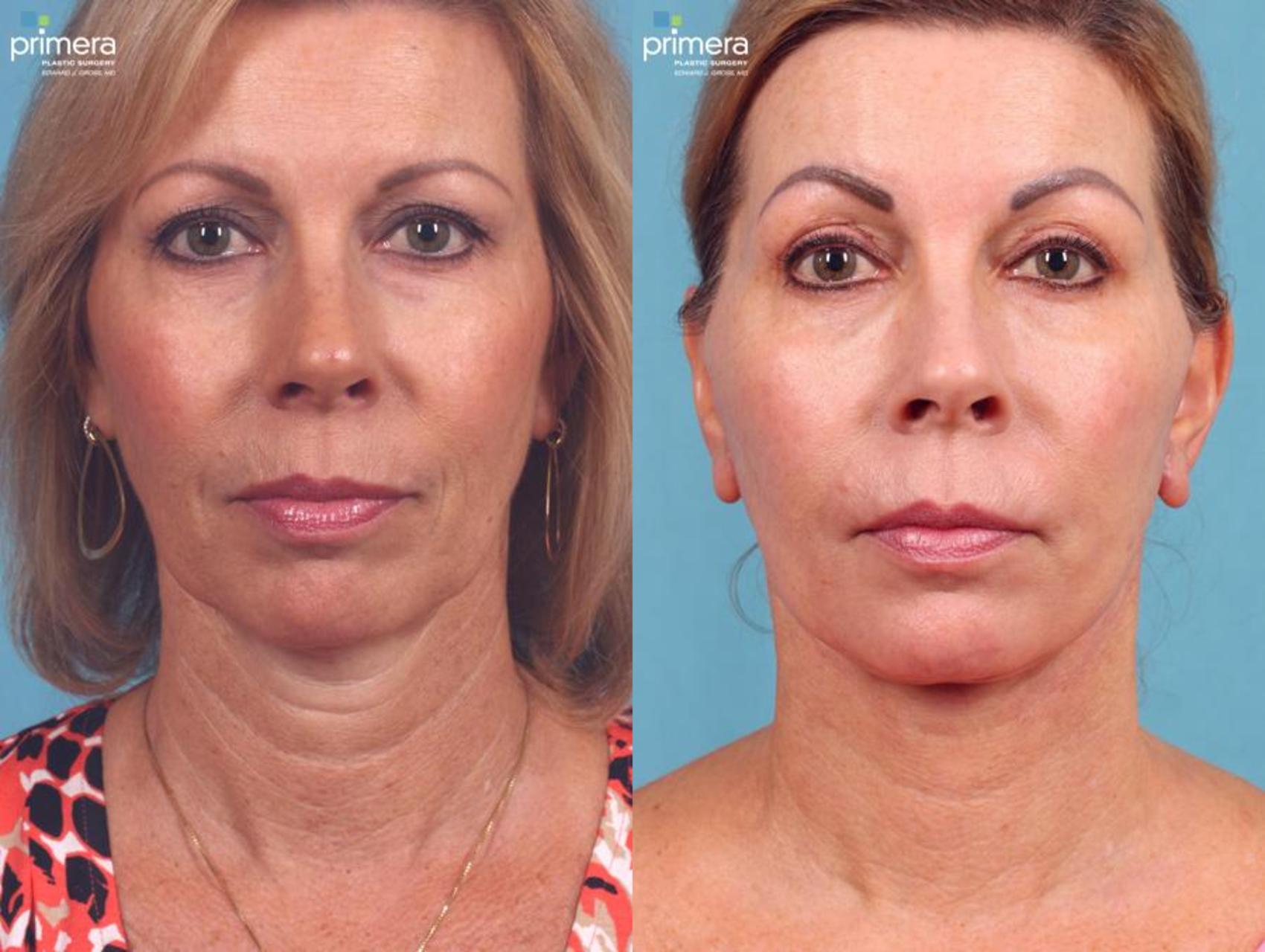 Mini Facelift Before and After Pictures Case 445 | Orlando, Winter Park ...