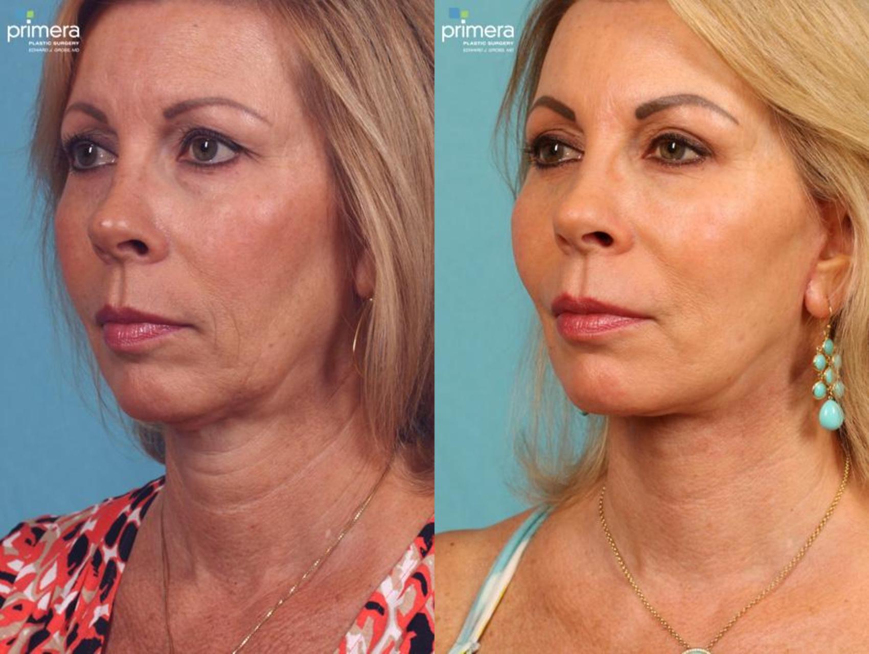 Mini Facelift Before & After Photos Patient 445 Orlando