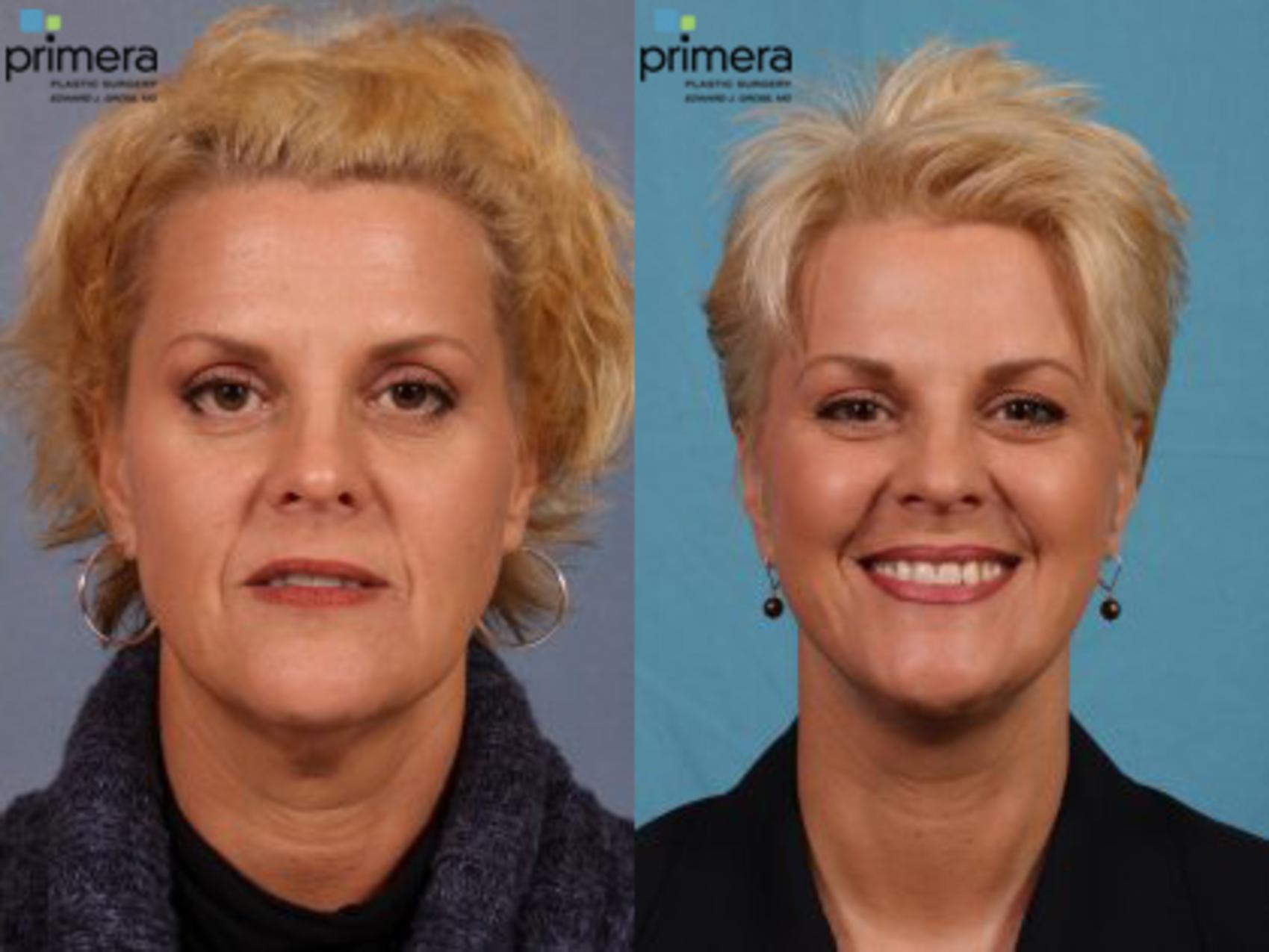 Neck & Face Liposuction Before & After Photos Patient 47