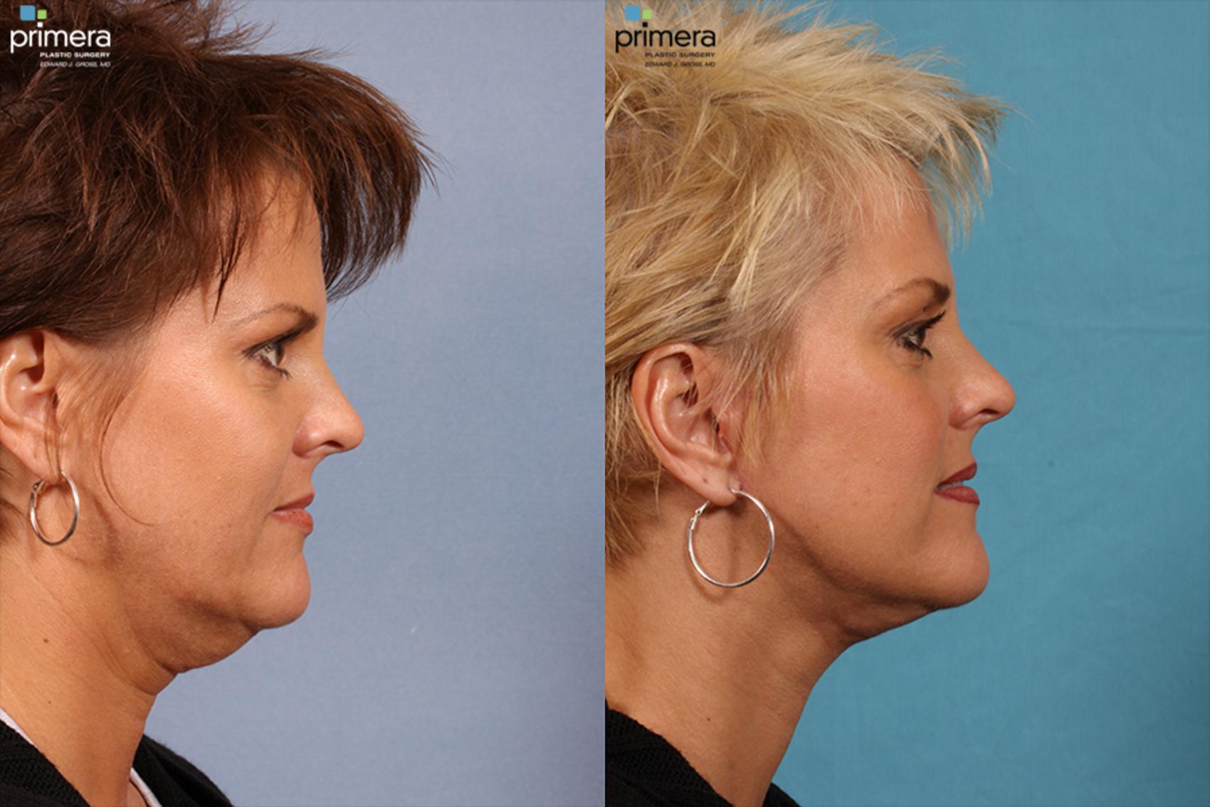 Mini Facelift Before And After Pictures Case Orlando Florida Primera Plastic Surgery