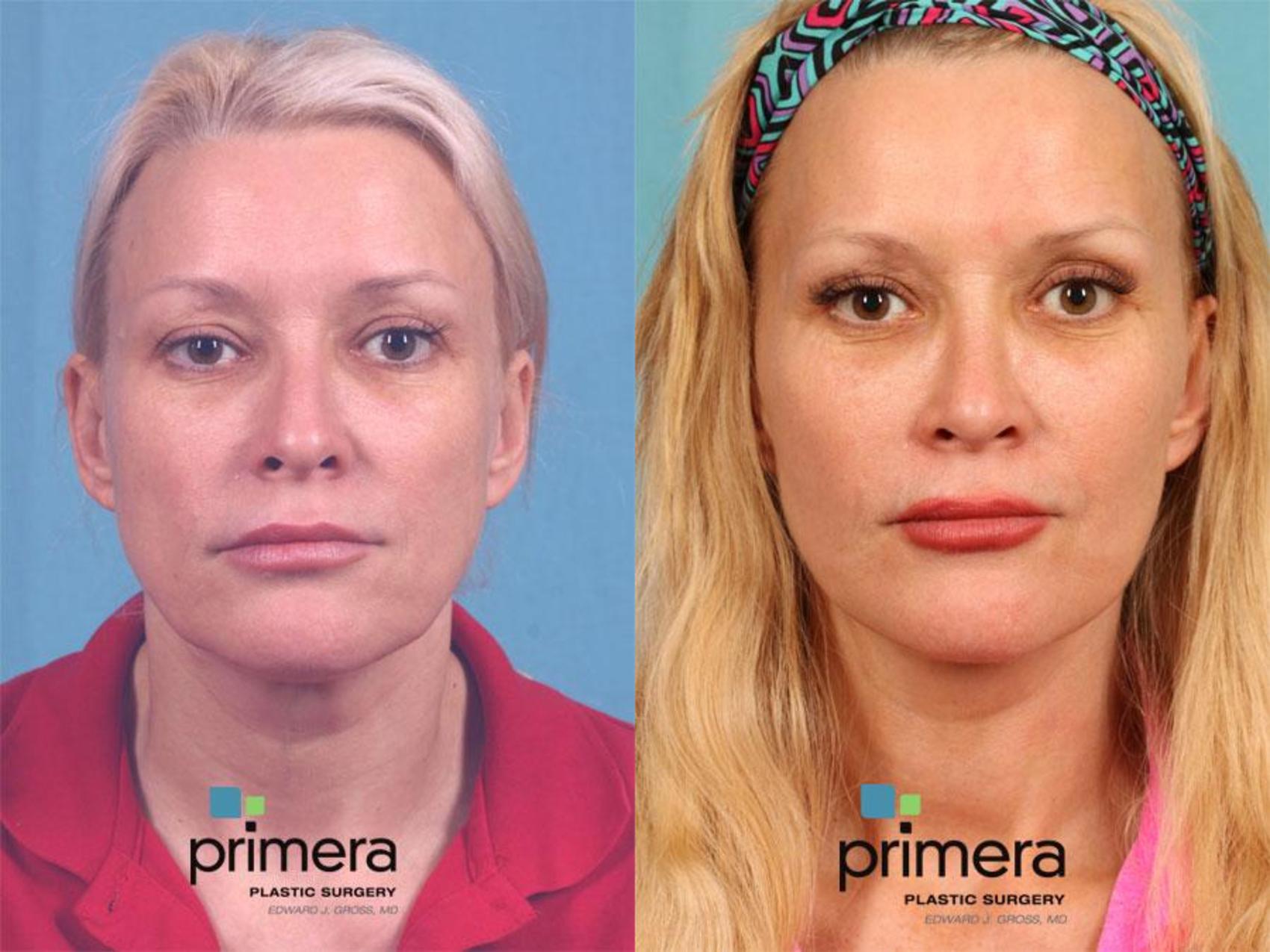 Mini Facelift Before & After Photos Patient 495 Orlando