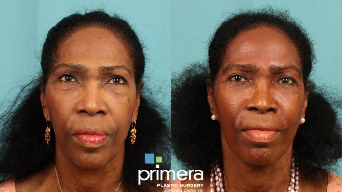 Before & After Blepharoplasty Case 529 view-1 View in Orlando, Florida