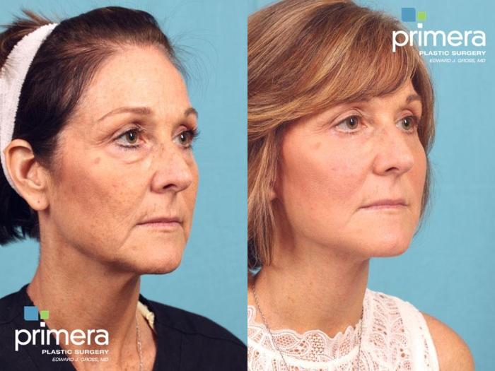 Before & After Blepharoplasty Case 554 view-1 View in Orlando, Florida